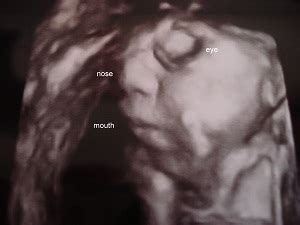 ultrasound pictures of anencephaly