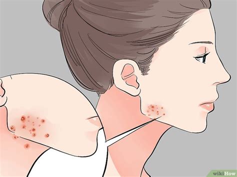 How to Treat a Cyst by Yourself (and When to See a Doctor)