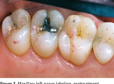 occlusal adjustment semantic scholar