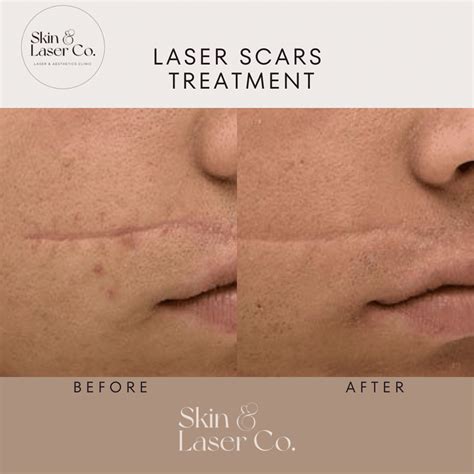 Scarring Treatment - Skin Laser Co