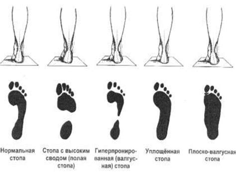 Своды стопы. Плоскостопие - презентация онлайн