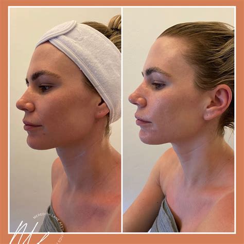 Before and After: results after our Biologique Recherche Signature 90 ...