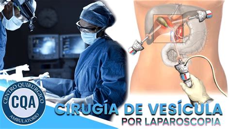Como É A Cirurgia De Vesícula - Cirugía de vesícula por laparoscopia. (COLECISTECTOMÍA) - YouTube