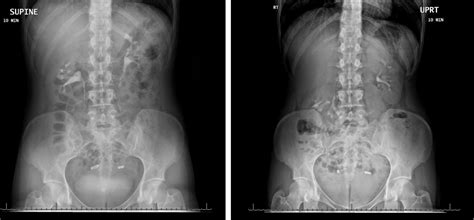 Floating kidney | BMJ Case Reports