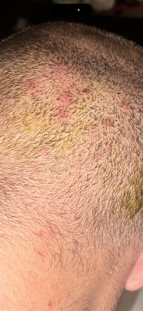 Fungal (?) folliculitis on scalp : r/Folliculitis