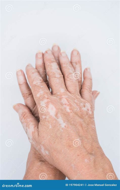 Old Hands With Vitiligo Skin Disorder On White Background Stock Image ...