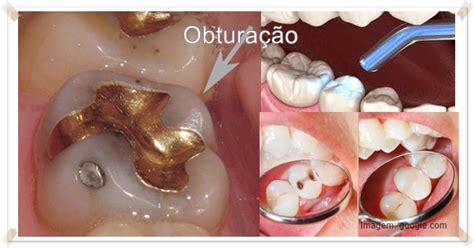 Obturação Caiu Mas Não Dói - Obturação Dentária: Restaurando a Saúde e Estética dos Dentes