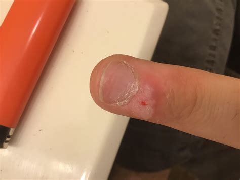 Am i making progress on this wart? : r/Warts