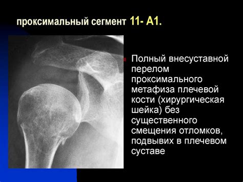 Переломы плечевой кости - презентация онлайн