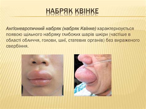 Обстеження пацієнтів із алергічними проблемами - презентация онлайн