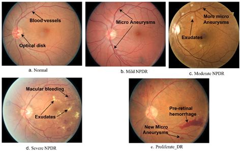 Nursing Diagnosis Diabetic Retinopathy at Henry Copeland blog