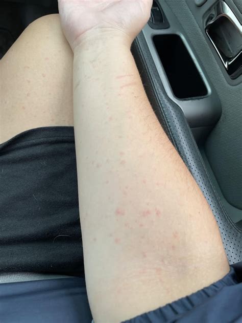 Lamotrigine rash? : r/Lamotrigine
