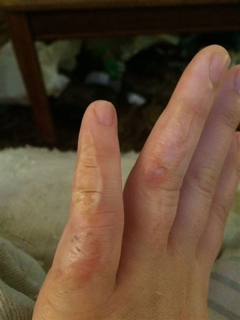 how to get a stuck ring off 3