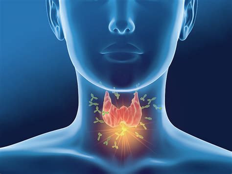 Hashimoto's Thyroiditis – An Autoimmune Disease That Leads To ...