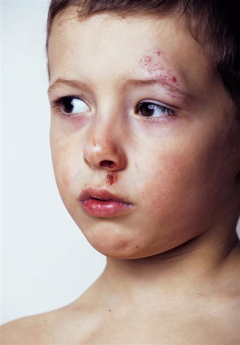 bleed forehead girl stock   royalty  stock