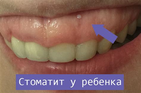 Как выглядит стоматит на десне фото