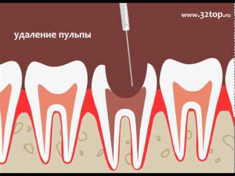 Хирургическое лечение пульпита - YouTube