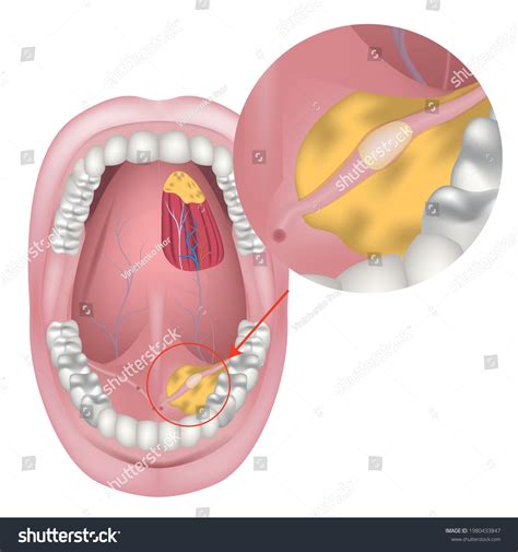 259 Tongue Frenulum Images, Stock Photos & Vectors | Shutterstock