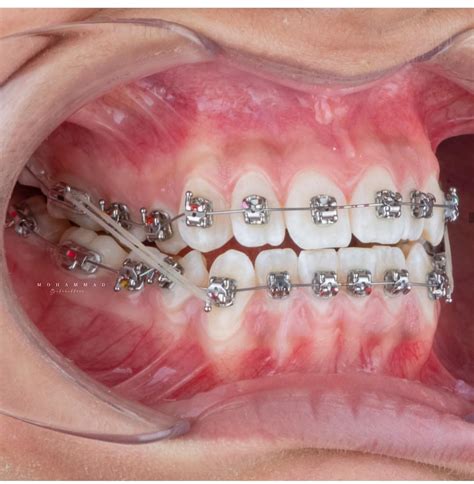 how to put a rubber band on braces