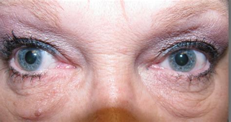 external incisional tear drain surgery