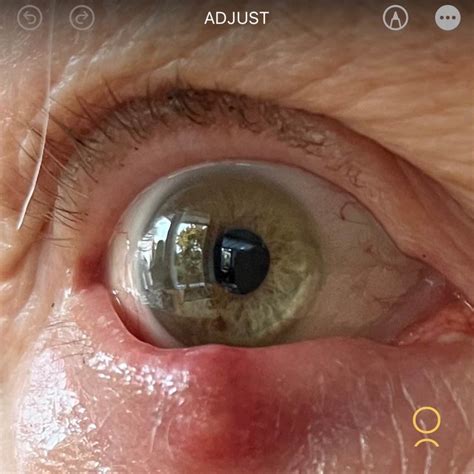 eye infection  chalazion removal infoupdateorg