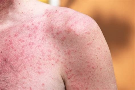 Потница у взрослых на фото: какие симптомы и чем лечить