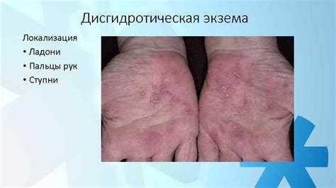 СНК Дерматовенерологии ЭКЗЕМА Докладчики Дудочкина Н П Серенко