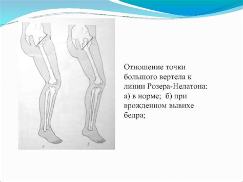вывих у детей презентация, доклад