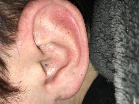 Anyone know how to get rid of this blackhead in my ear? I’ve had it for