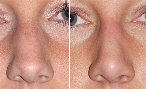 female nose front view