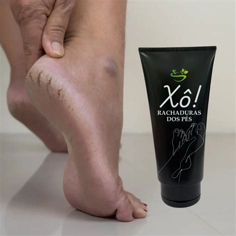 Qual O Melhor Calçado Para Evitar Rachaduras Nos Pés - Qual o Melhor Creme para Rachaduras nos Pés? Descubra Como Tratar e ...