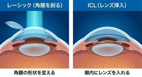 【医師監修】品川近視クリニックで2回目のレーシックは可能？費用・保証期間・リスクを徹底解説