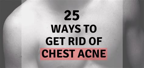 25 Ways to Get Rid Of Chest Acne - MangoLift