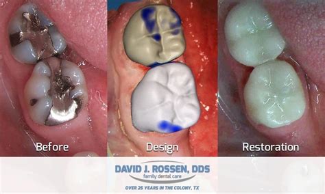 CEREC Crowns Before and After Photos