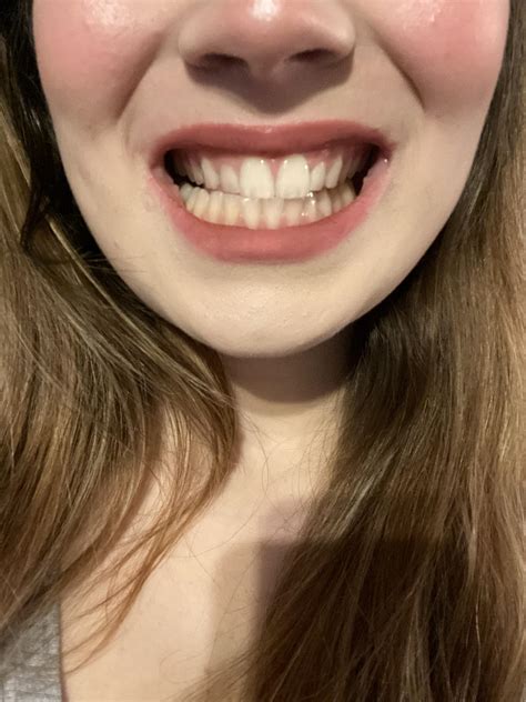 Can Your Jaw Be Misaligned at Stephen Jolly blog
