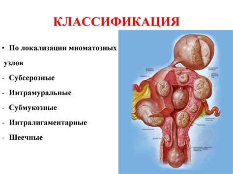 Миома матки - презентация онлайн