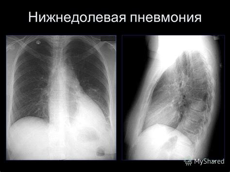 Презентация на тему: "Рентгенодиагностика пневмоний к.м.н. Шумаков А.В ...