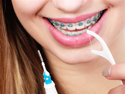 Braces Colors for Whiter Teeth | Godley Family Orthodontics