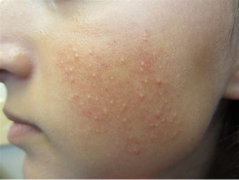 keratosis follicularis face keratosis pilarischicken skin ai beauty