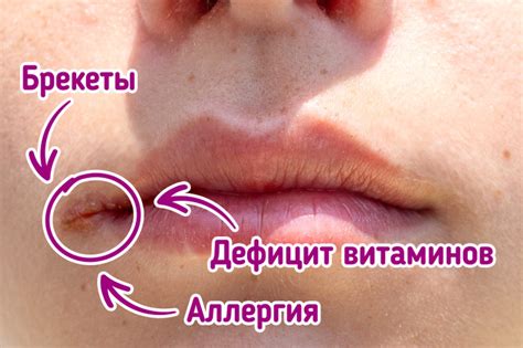 Почему трескаются уголки губ / Бери и делай