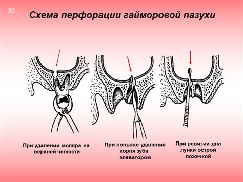ОДОНТОГЕННЫЙ ГАЙМОРИТ Два крайних типа гайморовой пазухи Пневматический