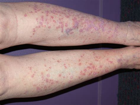 lichen planus  natural herbal remedies lichen planus