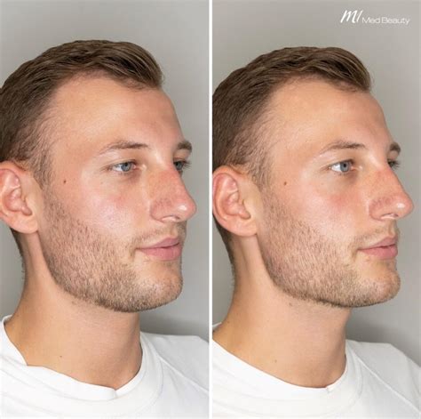 Jawline-Behandlung mit Hyaluronsäure bei M1 Med Beauty