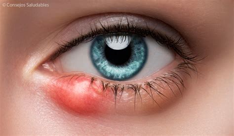 Orzuelos en los ojos: Causas, Prevención y Soluciones Caseras