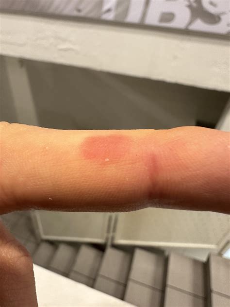 Red itchy spot? : r/DermatologyQuestions