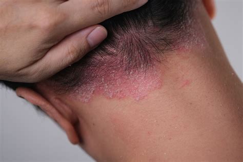 understanding scalp psoriasis    treat
