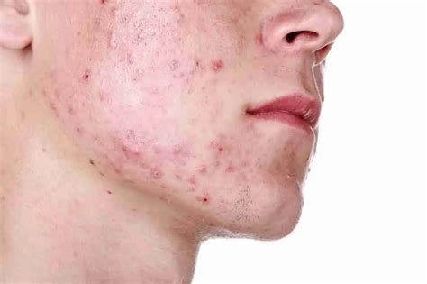 Teenage Acne - What You Need To Know – AF Health
