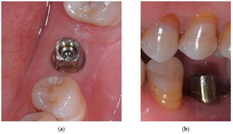 Abutment Supported Vs Implant Supported Crown at Levi Skipper blog