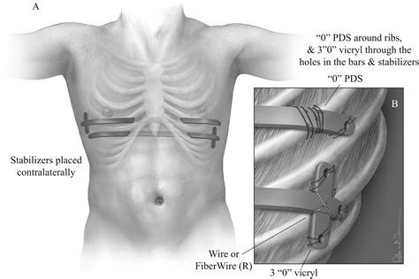 The Minimally Invasive Repair of Pectus Excavatum - Operative