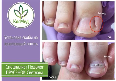 Лечение вросшего ногтя. Установка скоб. Купчино